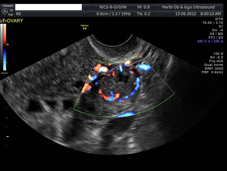 Pelvic Ultrasound - POGU