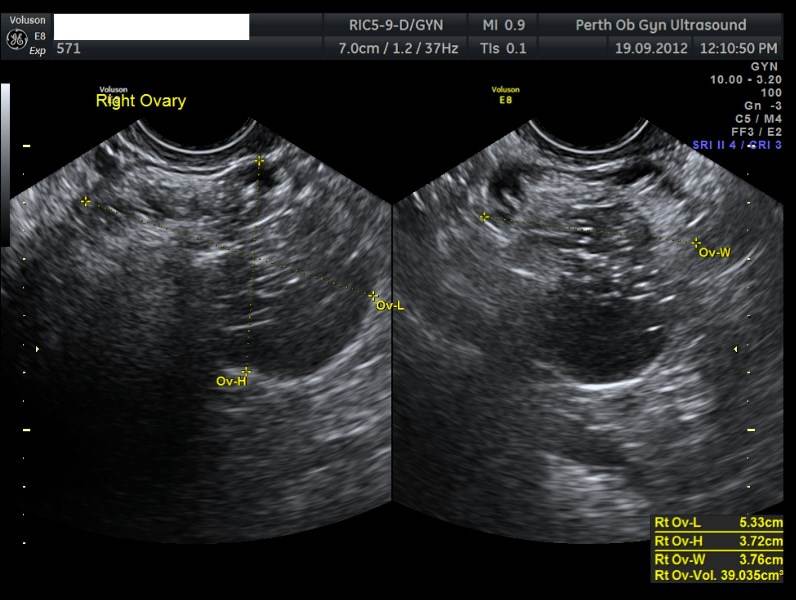 Pelvic Ultrasound - POGU