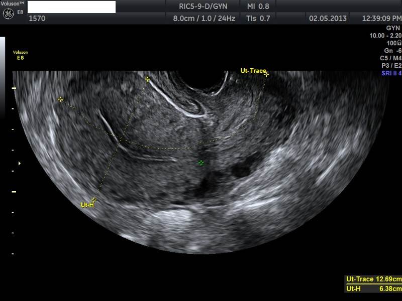 Pelvic Ultrasound - POGU