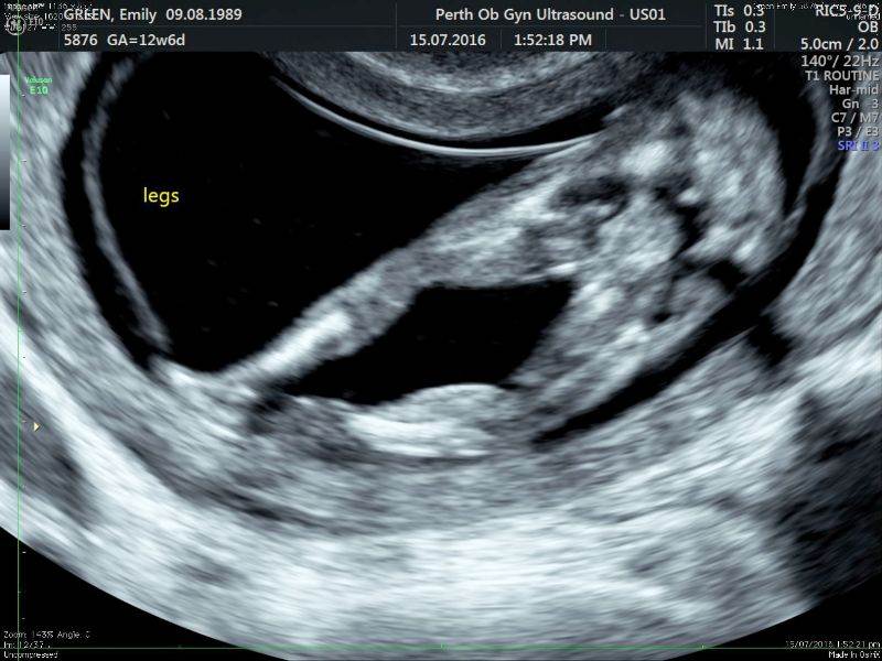 First Trimester Screening Gallery - POGU