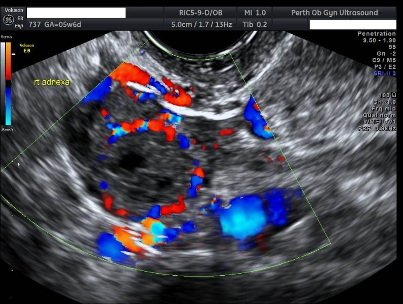 Early pregnancy scan gallery - POGU