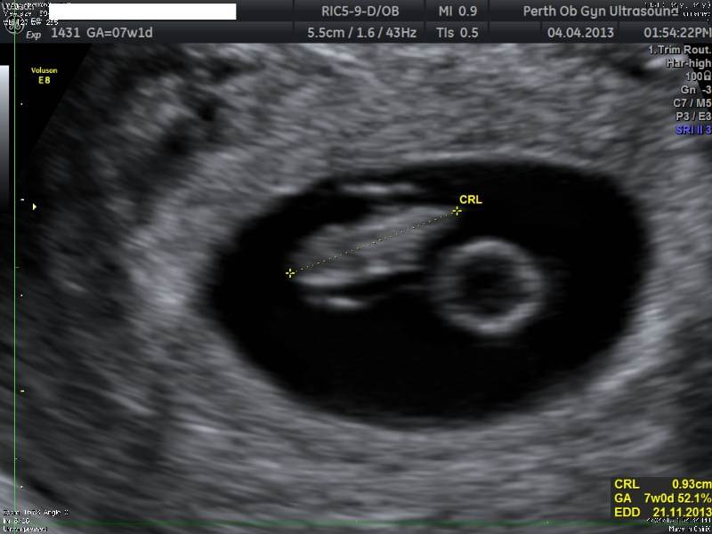 Early pregnancy scan gallery - POGU