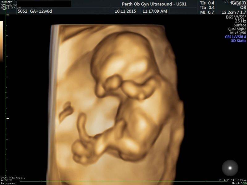 First Trimester Screening Gallery - POGU