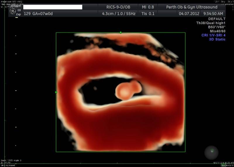 Early pregnancy scan gallery - POGU