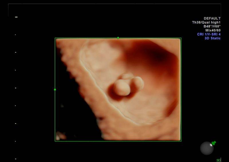 Early pregnancy scan gallery - POGU